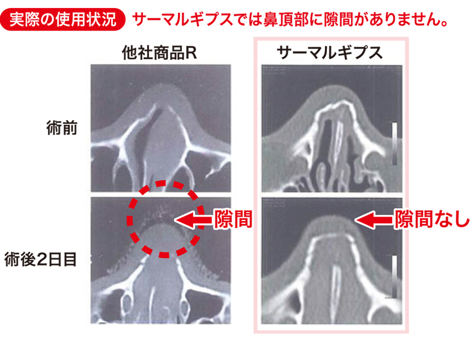 サーマルギプス 鼻用 注目製品 東洋アルミニウム株式会社