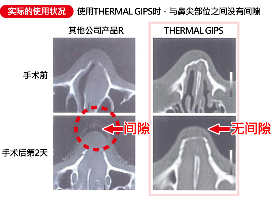 东洋铝业株式会社 产品介绍 热门产品 Thermal Gips 鼻部用